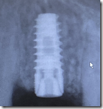 Dental Implant